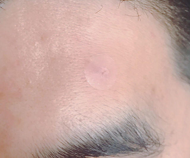 Acne Cover & Treatment Patch