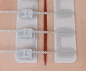 ZipStitch Laceration Kit